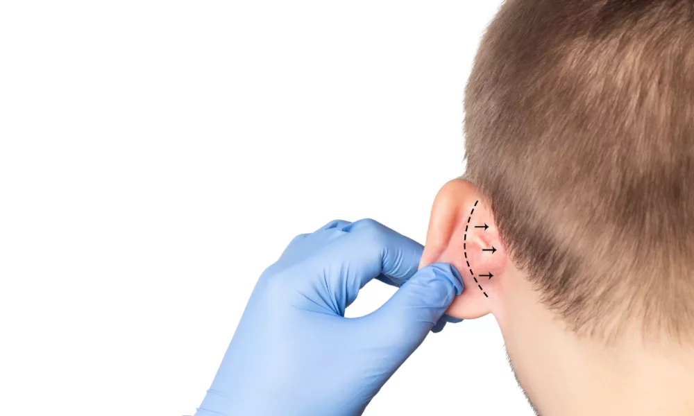 Reshaping Confidence: The Art of Otoplasty for Prominent Ears Introduction