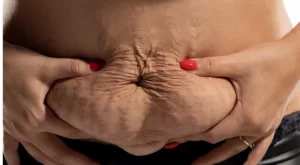 Post pregnancy cosmetic deformities of the abdomen