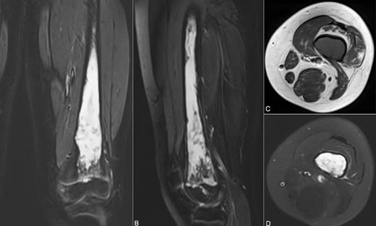 Chronic osteomyelitis: reconstructive surgeon’s role - Dr Aashish ...