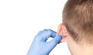 Reshaping Confidence: The Art of Otoplasty for Prominent Ears Introduction