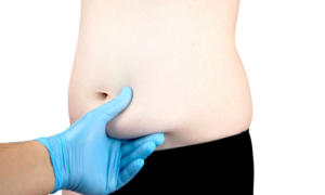 LOOK GOOD AND FEEL GOOD : THE BENEFITS OF ABDOMINOPLASTY/TUMMY TUCK PROCEDURE